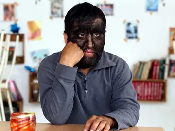 Chuy padece la enfermedad del "hombre lobo" Chuy padece la enfermedad del "hombre lobo"