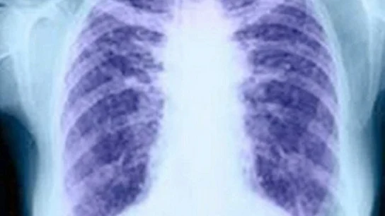 El cáncer de pulmón El cáncer de pulmón