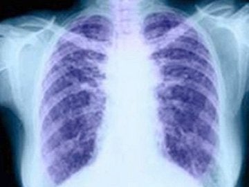 El cáncer de pulmón El cáncer de pulmón
