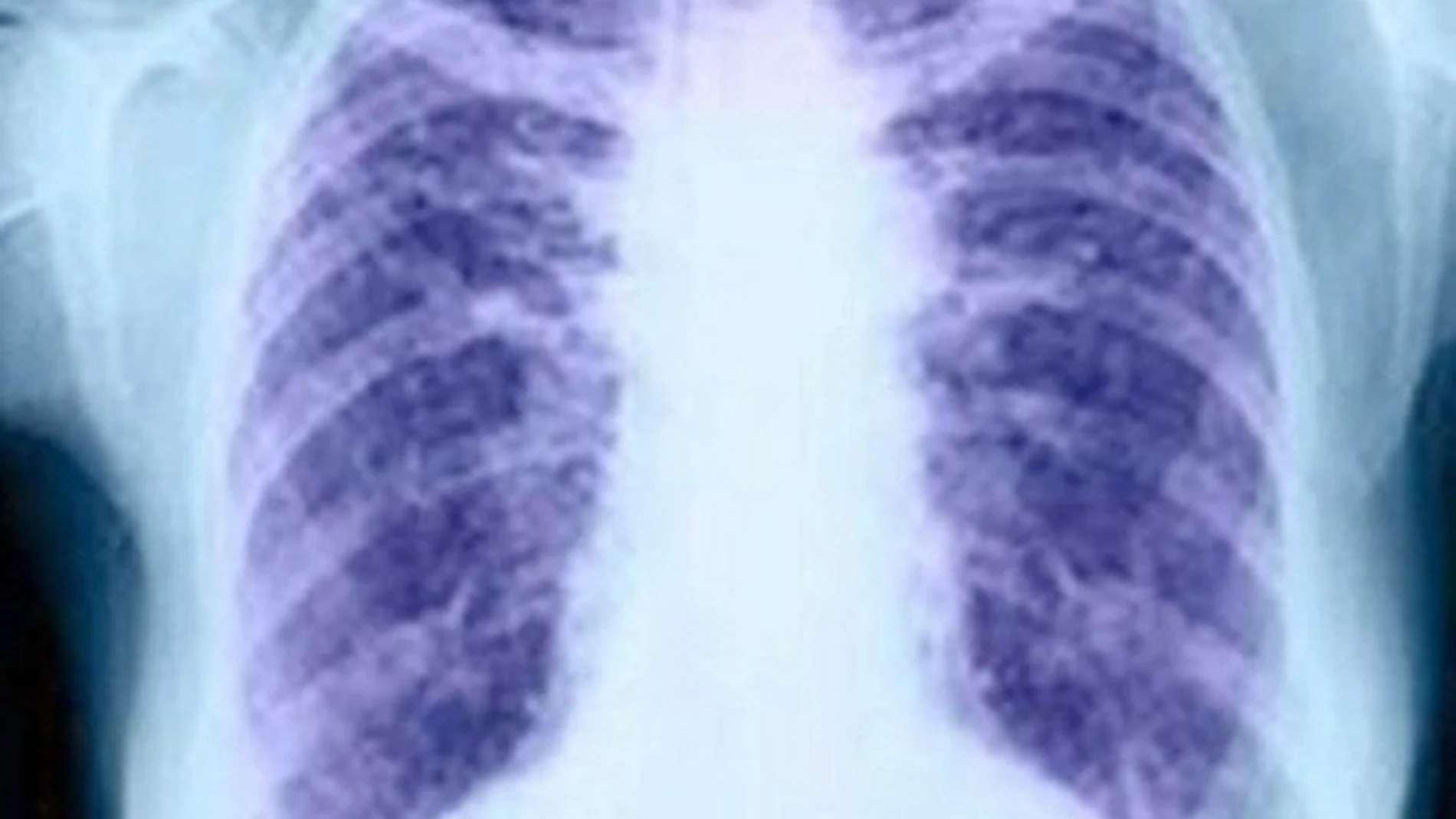 El cáncer de pulmón 