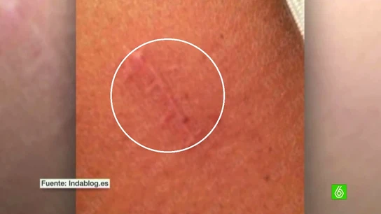 Cicatriz de la doctora de López Madrid Cicatriz de la doctora de López Madrid