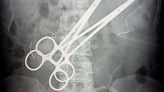 Radiografía de un paciente con dos pinzas quirúrgicas en su interior Radiografía de un paciente con dos pinzas quirúrgicas en su interior