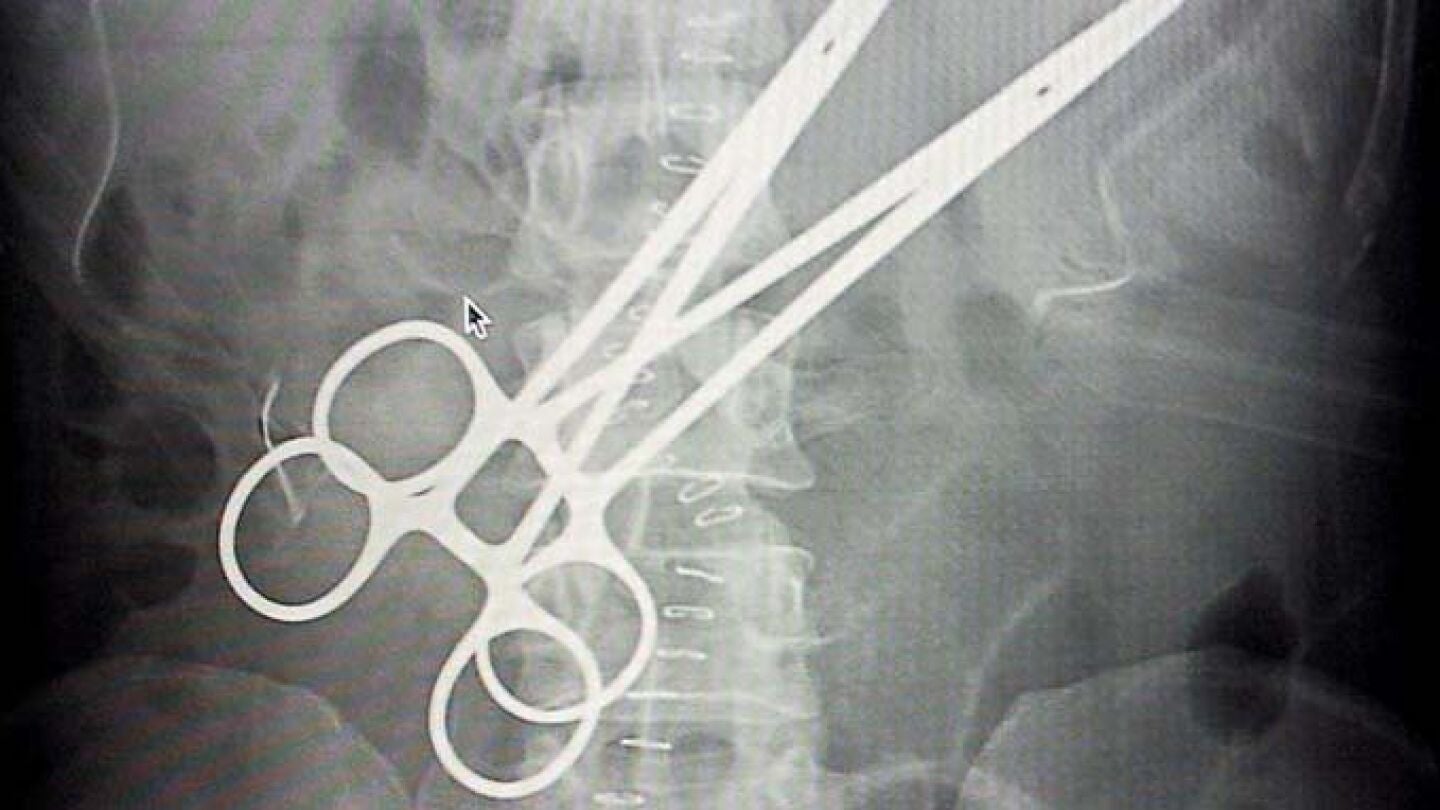 Radiograf&iacute;a de un paciente con dos pinzas quir&uacute;rgicas en su interior