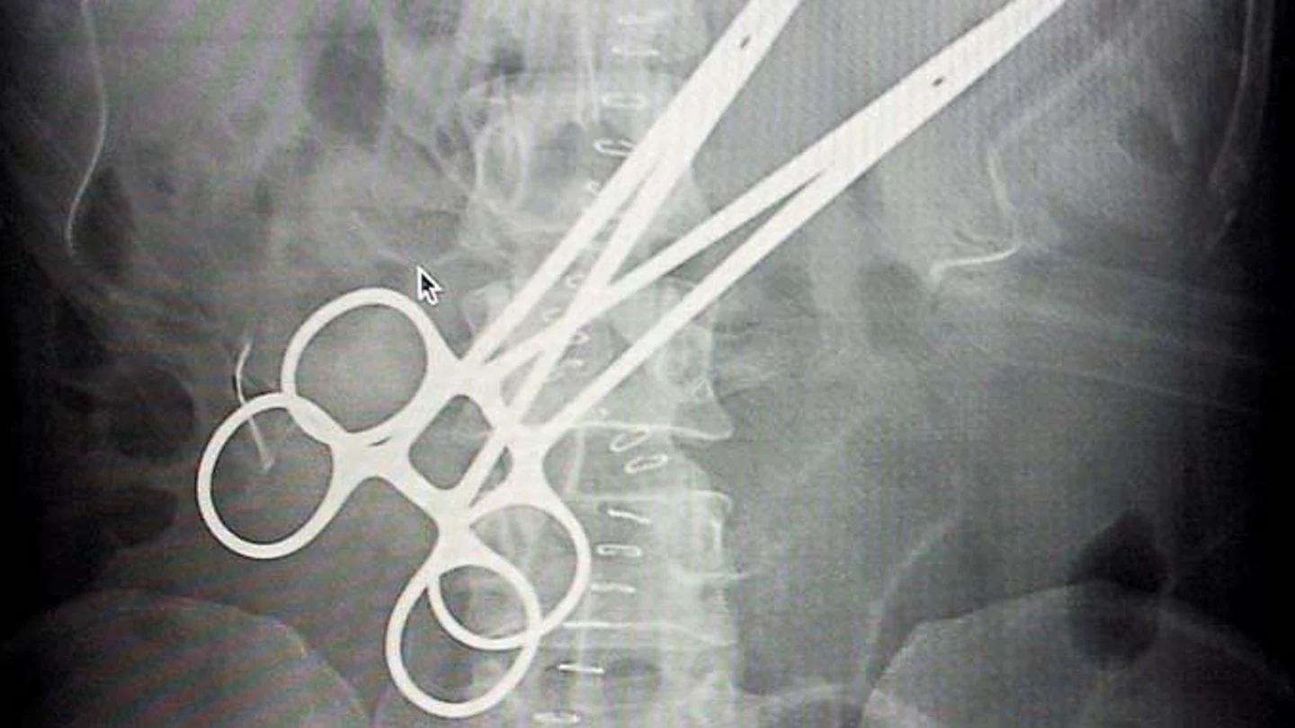 Radiografía de un paciente con dos pinzas quirúrgicas en su interior Radiografía de un paciente con dos pinzas quirúrgicas en su interior