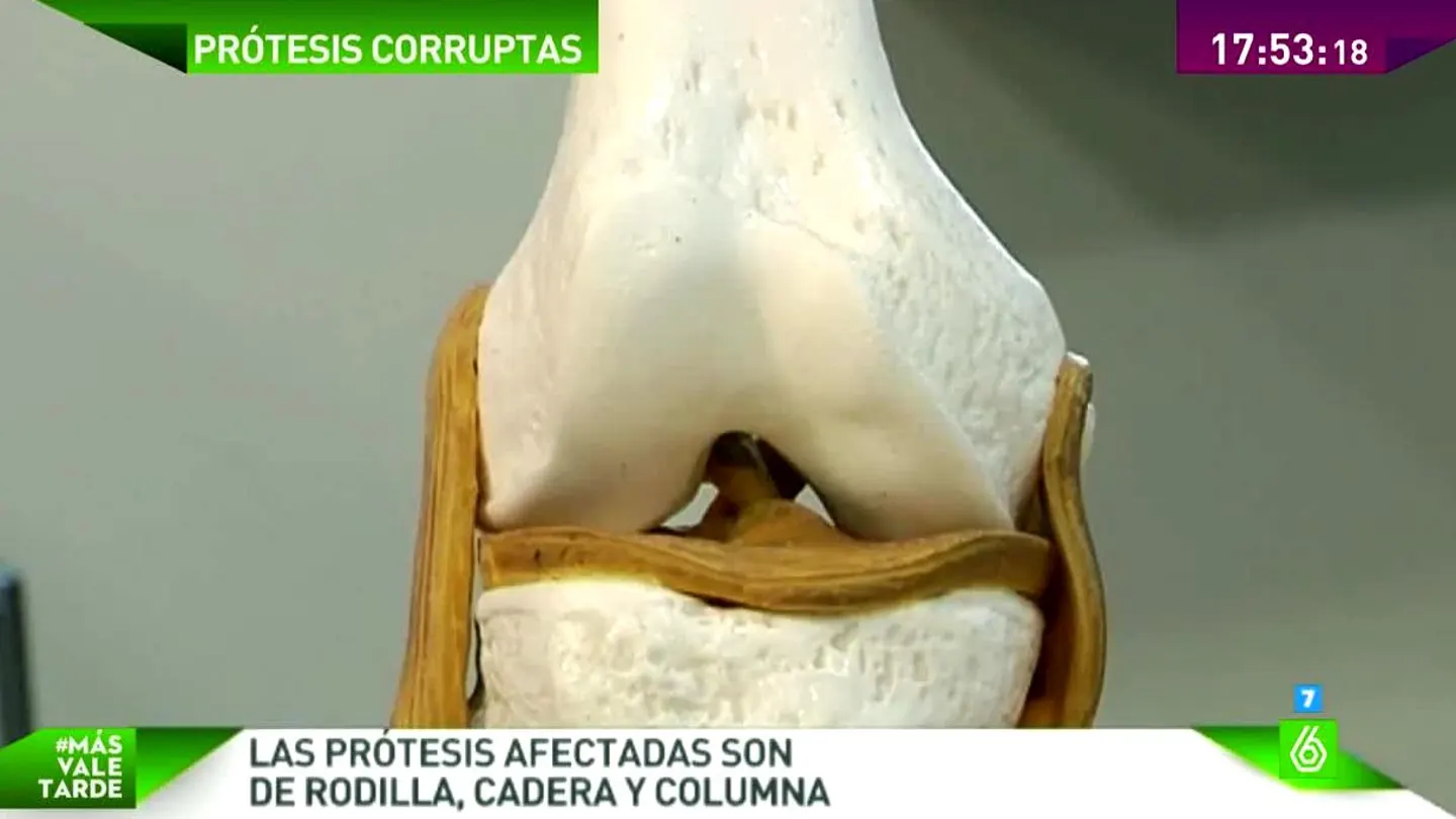 La Generalitat reconoce que 2.800 pacientes llevan prótesis defectuosas o caducadas La Generalitat reconoce que 2.800 pacientes llevan prótesis defectuosas o caducadas
