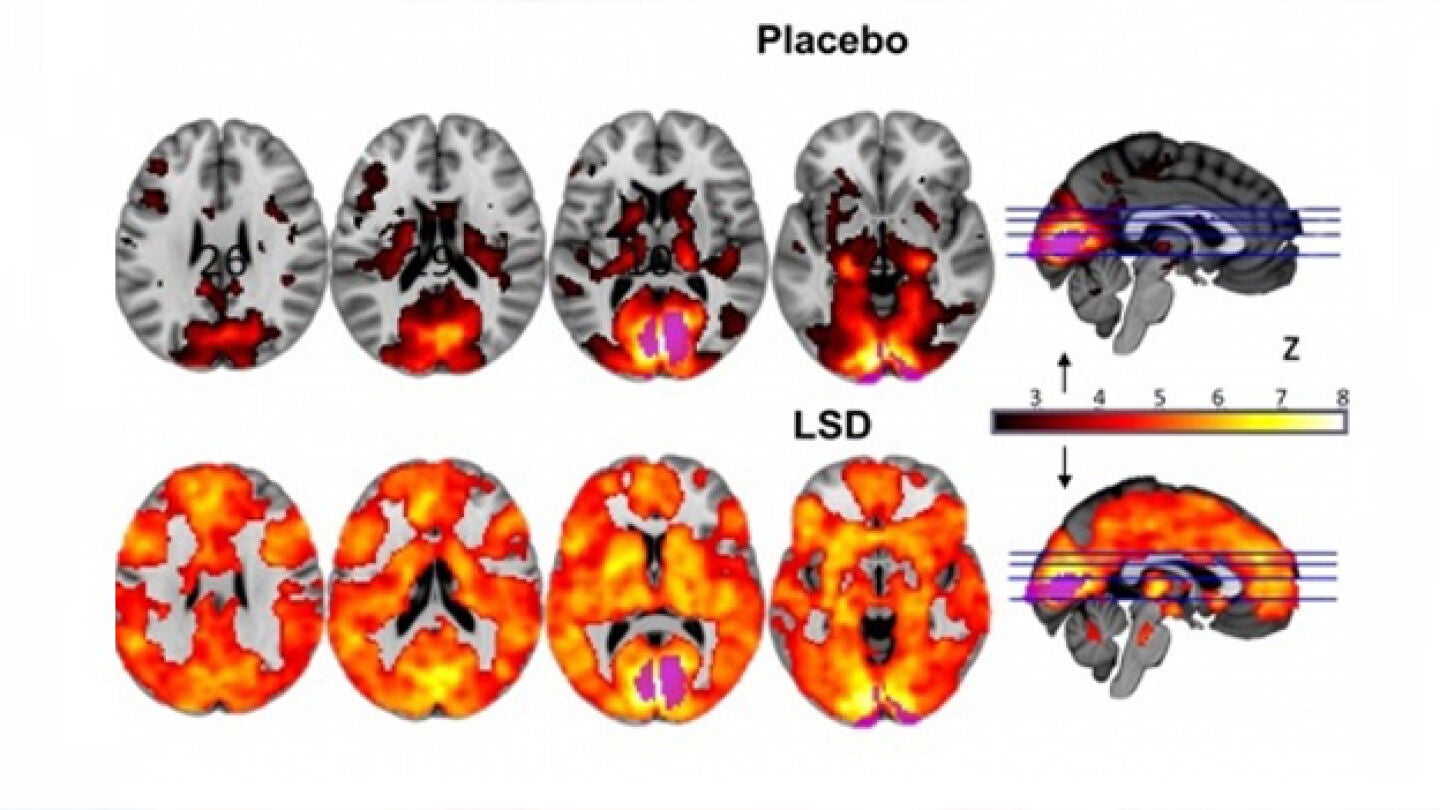 Comparaci&oacute;n del comportamiento del cerebro bajo los efectos del LSD y un placebo