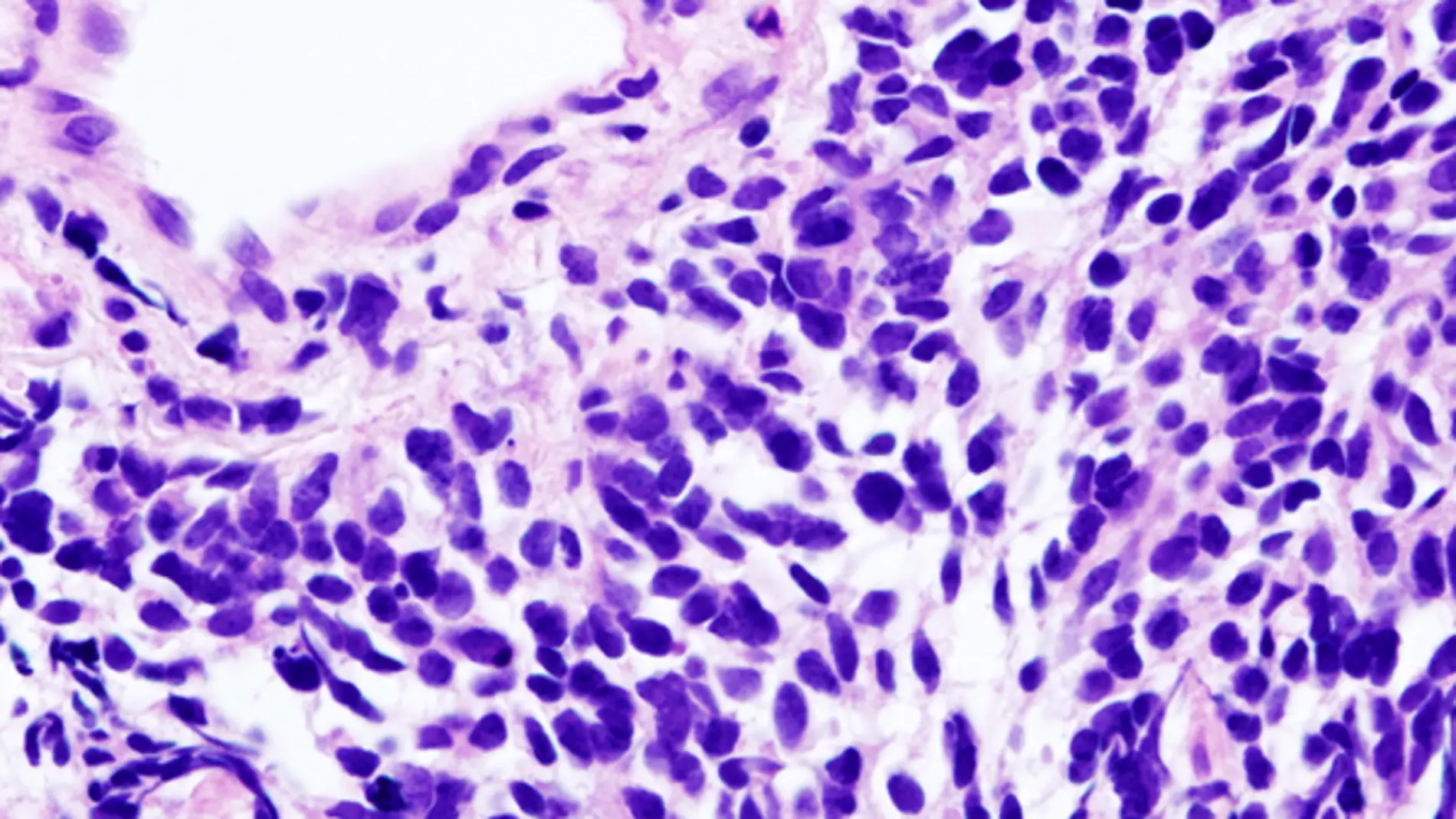 Carcinoma de pulmón de células pequeñas.