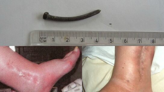 La mujer viv&iacute;a convencida de que los m&eacute;dicos se dejaron algo dentro de su tobillo cuando la operaron