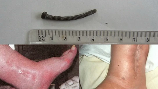 La mujer vivía convencida de que los médicos se dejaron algo dentro de su tobillo cuando la operaron La mujer vivía convencida de que los médicos se dejaron algo dentro de su tobillo cuando la operaron