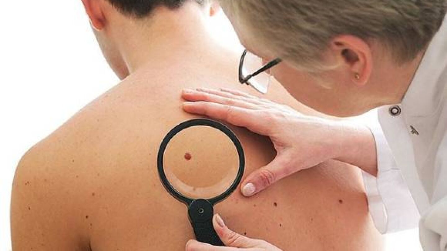 Uno de cada cinco pacientes habr&aacute; desarrollado c&aacute;ncer de piel al llegar a los 70 a&ntilde;os