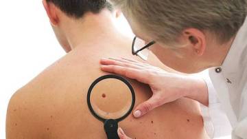Uno de cada cinco pacientes habrá desarrollado cáncer de piel al llegar a los 70 años