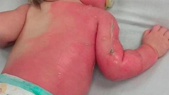 Bebé con quemaduras de segundo grado Bebé con quemaduras de segundo grado