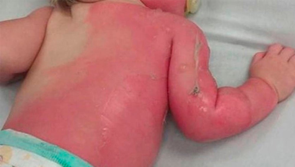 Bebé con quemaduras de segundo grado