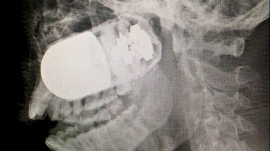 Fotograf&iacute;a cedida de la radiograf&iacute;a del rostro del soldado