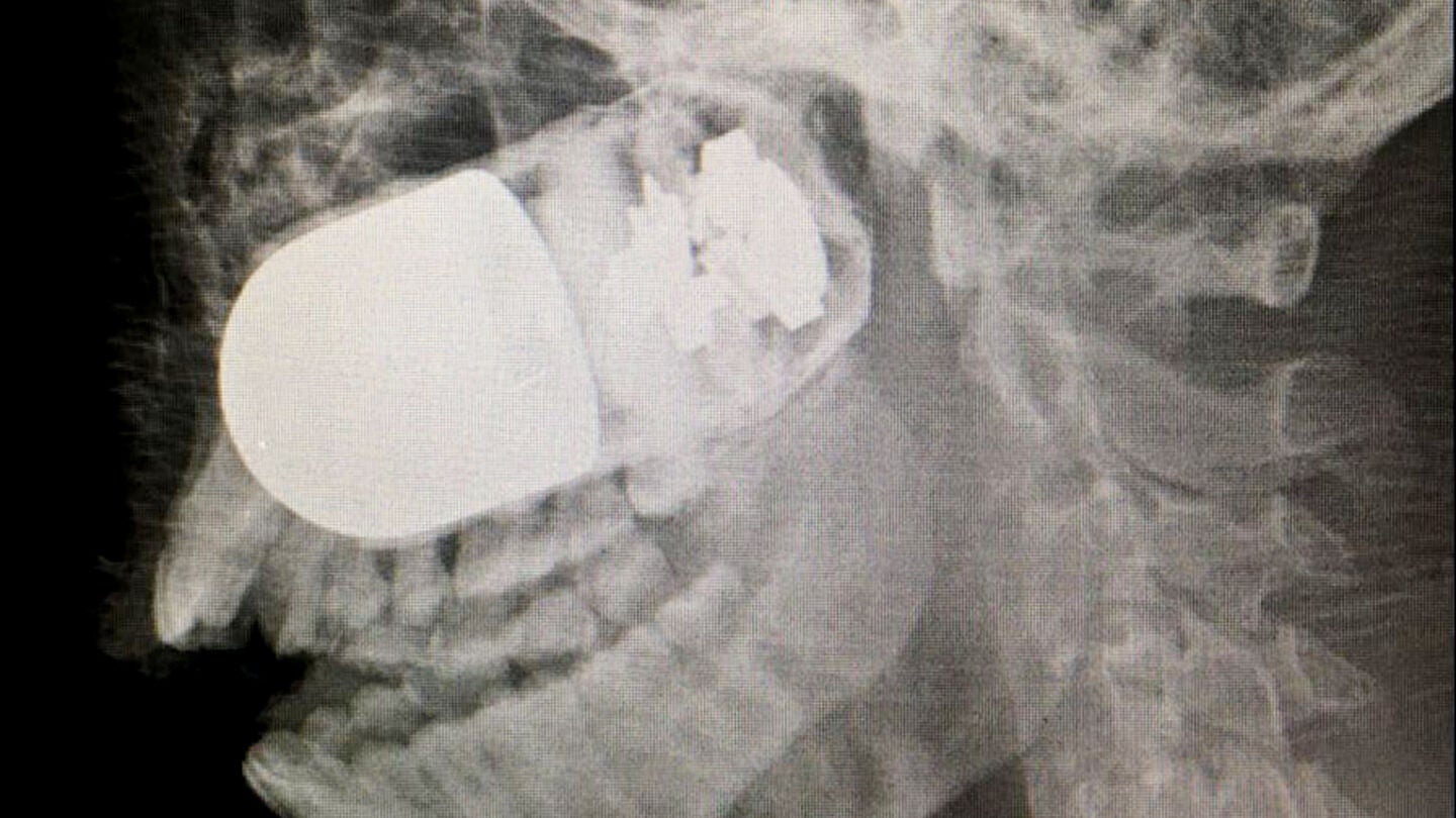 Fotograf&iacute;a cedida de la radiograf&iacute;a del rostro del soldado