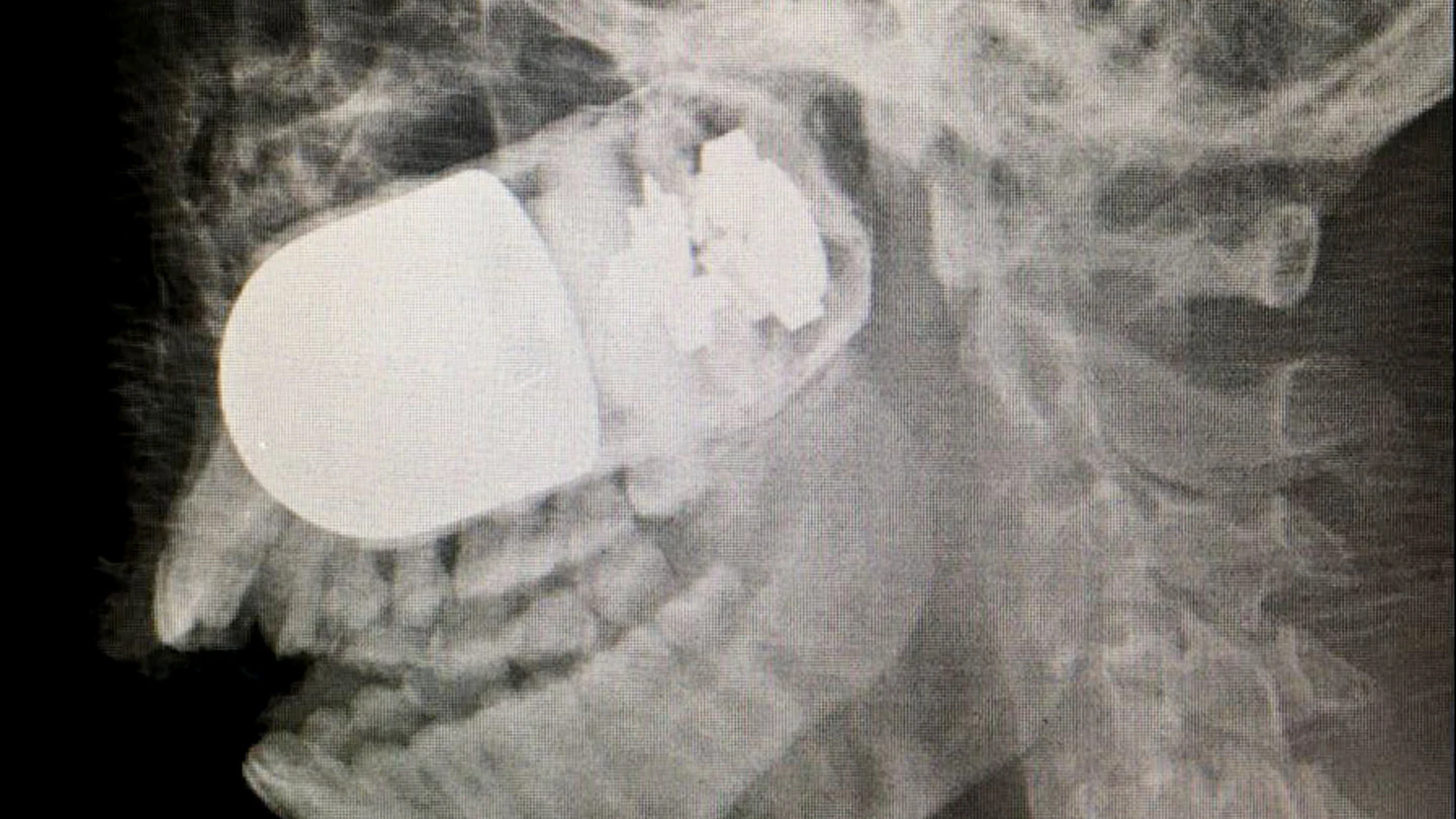 Fotografía cedida de la radiografía del rostro del soldado Fotografía cedida de la radiografía del rostro del soldado