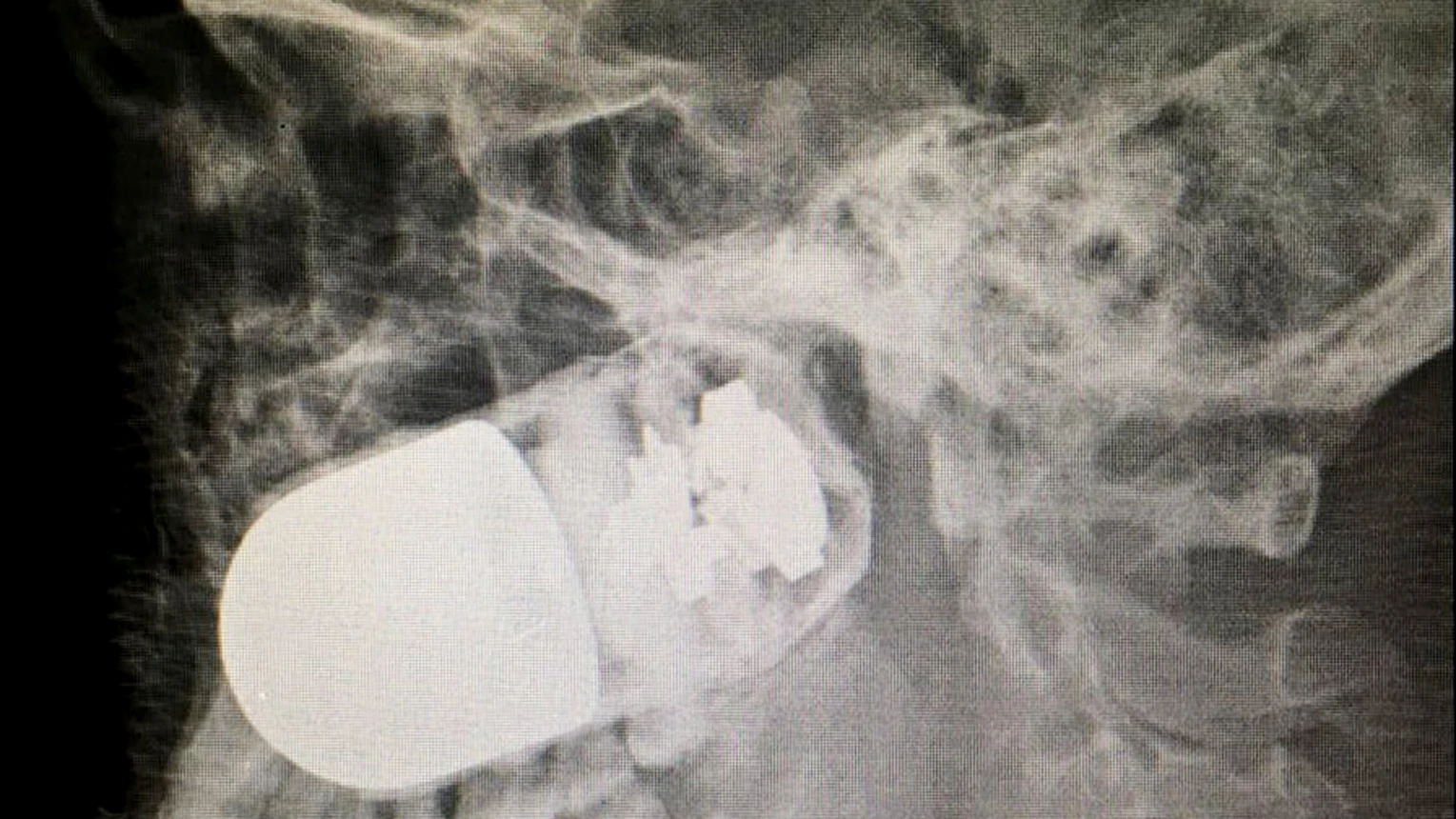 Fotografía cedida de la radiografía del rostro del soldado