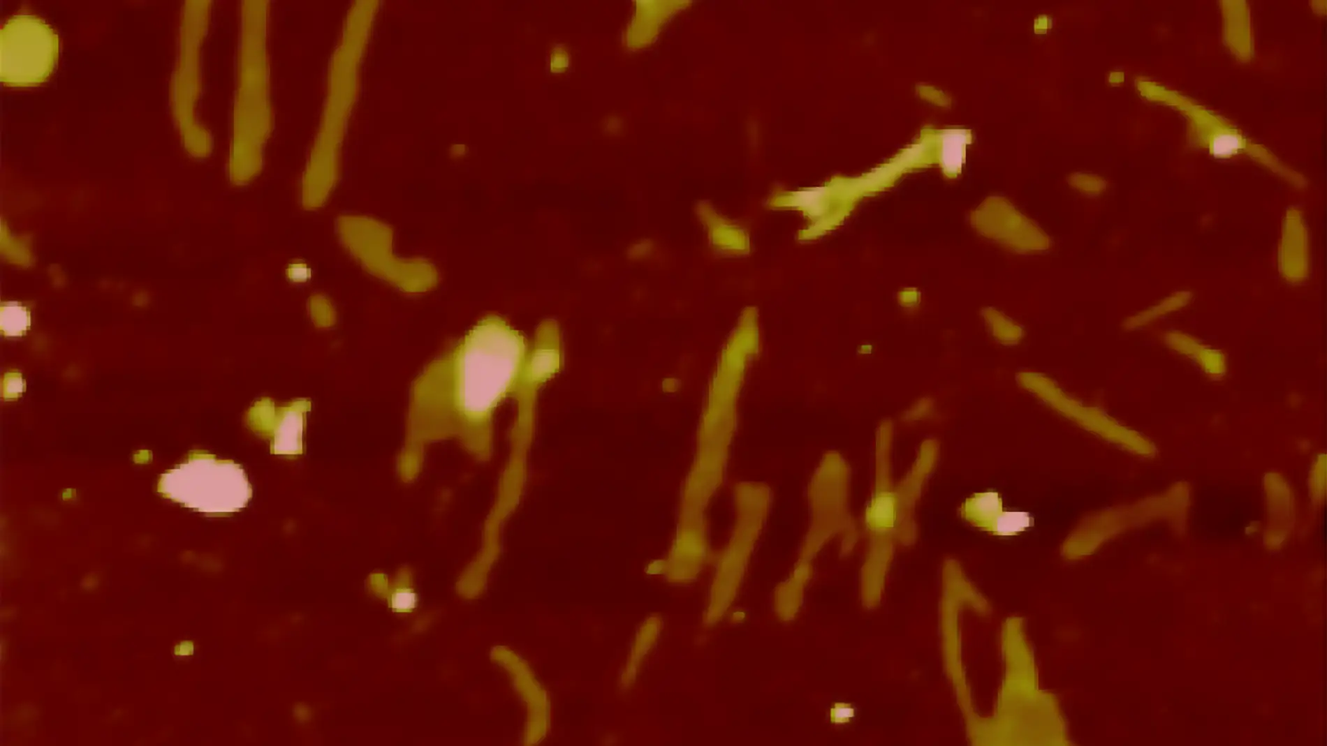Agregados de la proteína Receptor de And