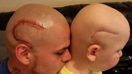 Un padre se tatúa la cicatriz de su hijo para que se sienta normal Un padre se tatúa la cicatriz de su hijo para que se sienta normal