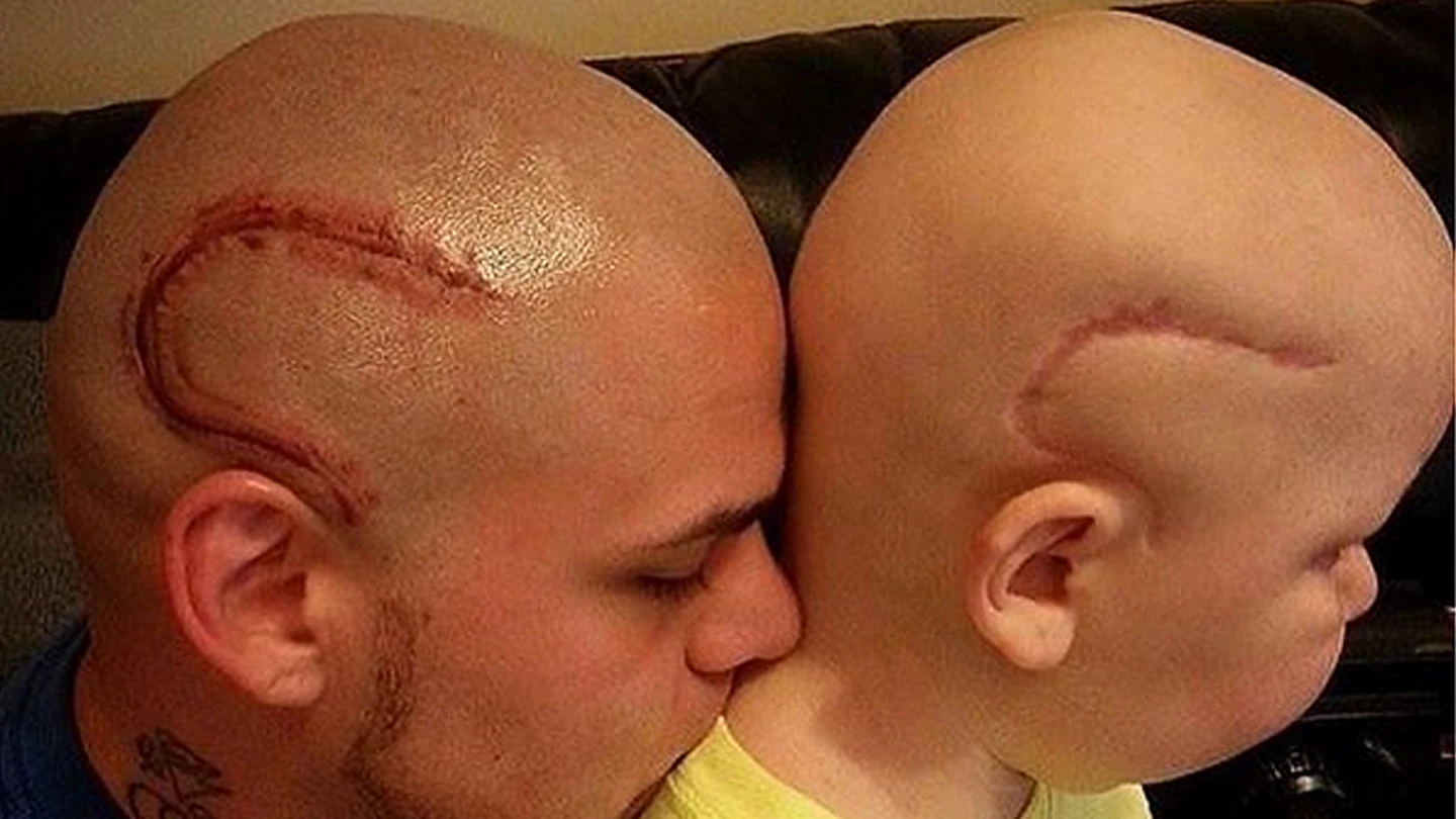 Un padre se tatúa la cicatriz de su hijo Un padre se tatúa la cicatriz de su hijo