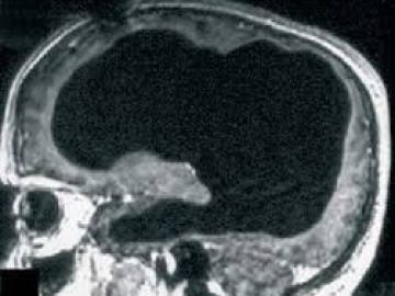 Escáner del cerebro del paciente