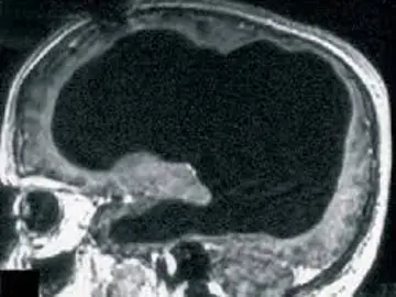 Escáner del cerebro del paciente Escáner del cerebro del paciente