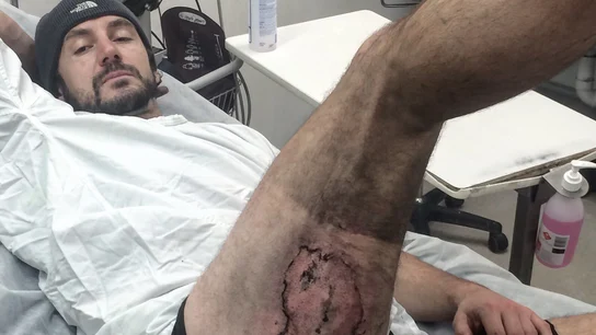La quemadura producida por la explosión de un iPhone en el muslo de Gareth Clear La quemadura producida por la explosión de un iPhone en el muslo de Gareth Clear