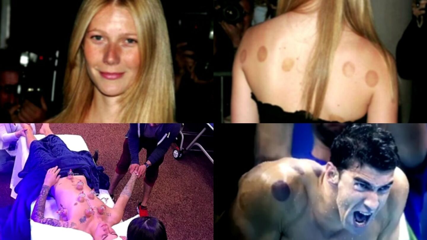 Cupping famosos