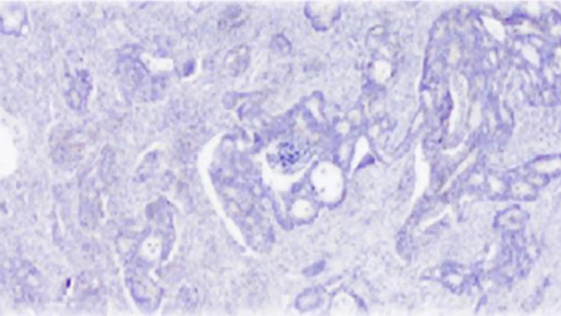 Cáncer de colon