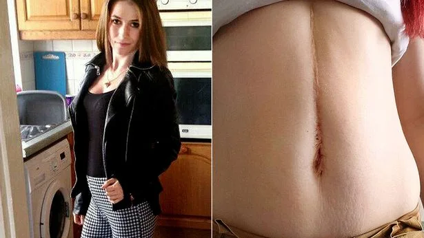 Jasmin Percival y su cicatriz tras la operación Jasmin Percival y su cicatriz tras la operación