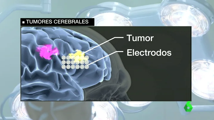Frame 41.518589 de: TUMOR CEREBRAL Frame 41.518589 de: TUMOR CEREBRAL