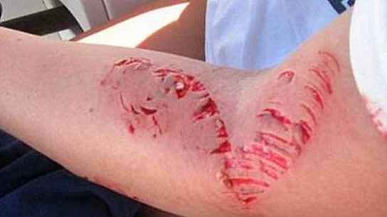 Imagen de la herida causada por la barracuda Imagen de la herida causada por la barracuda