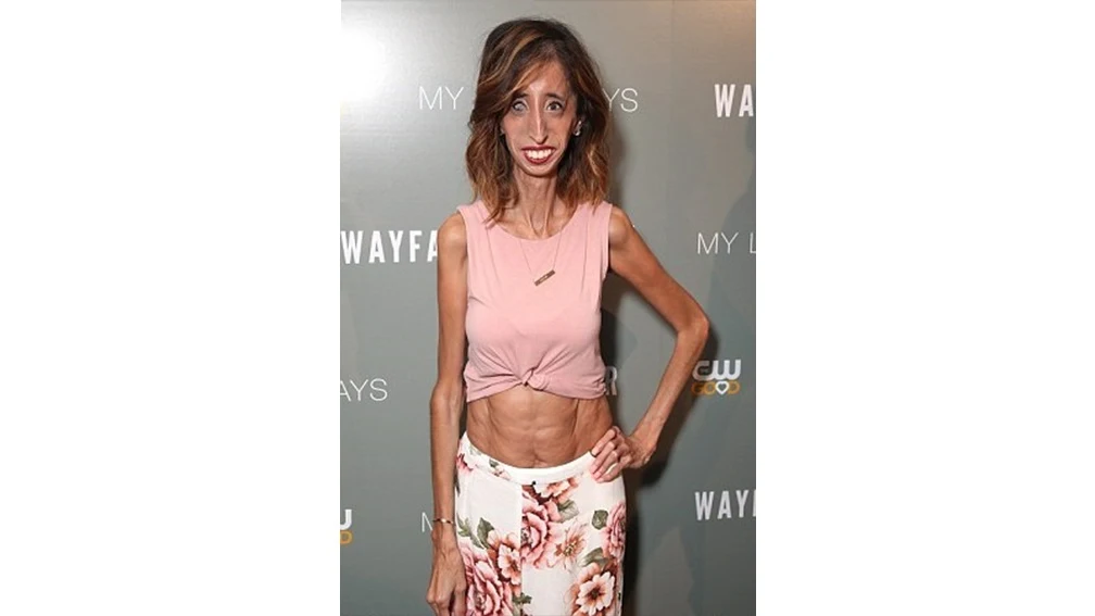 Lizzie Velasquez.