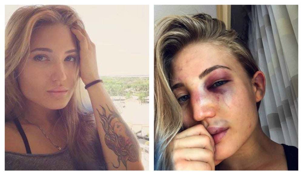 Anastasia Yankova, muestra como quedo su rostro tras un combate de MMA