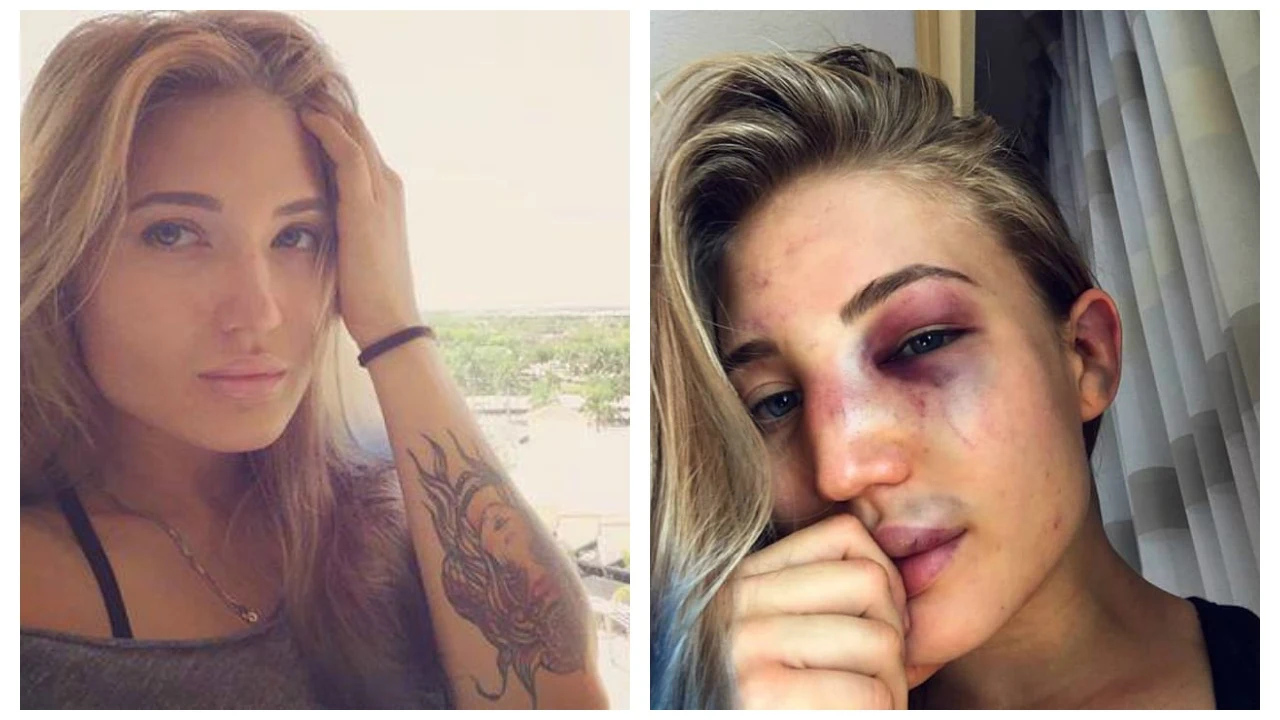 Anastasia Yankova, muestra como quedo su rostro tras un combate de MMA