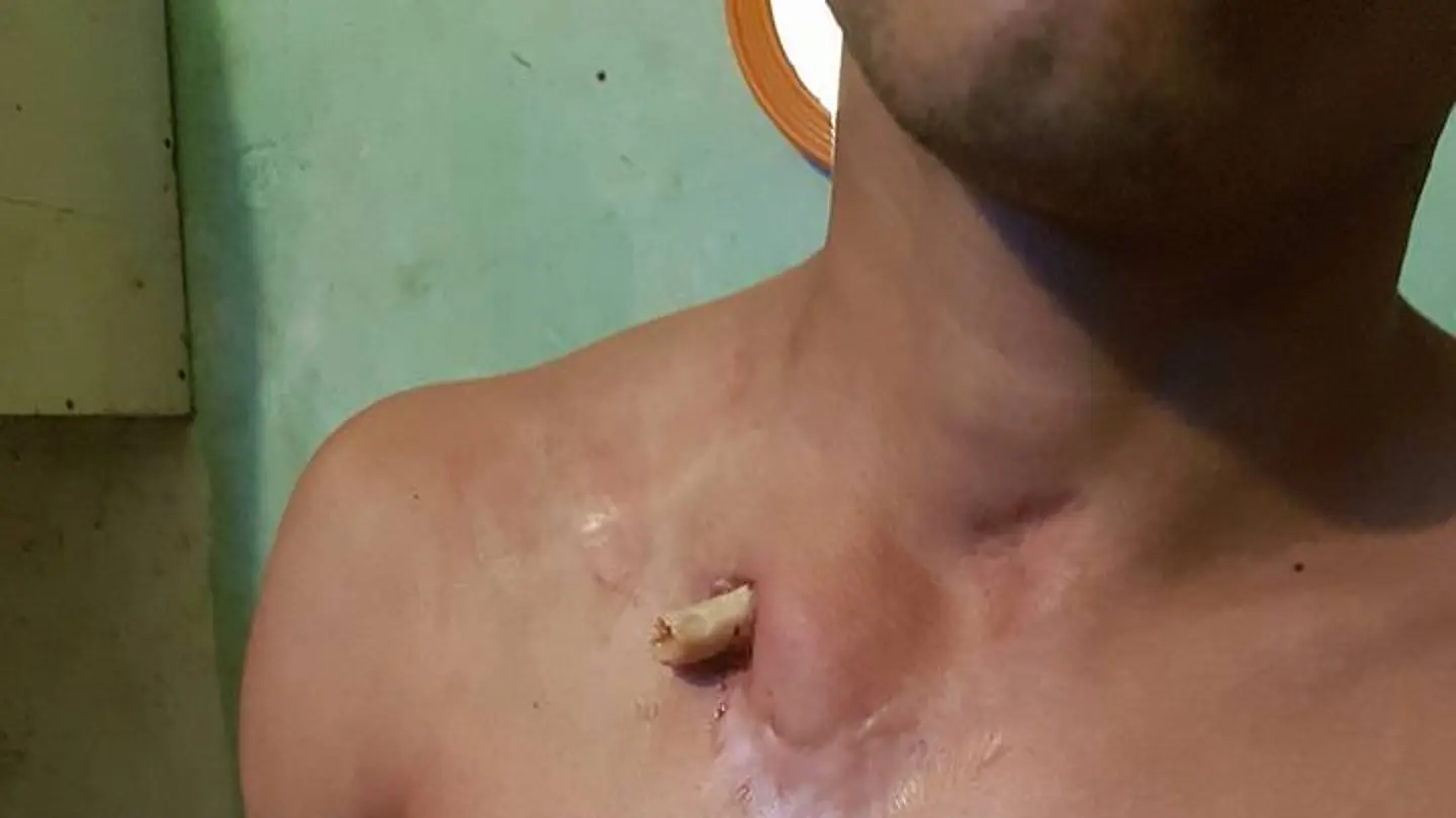 Reo de la Unidad Penal 15 con un hueso fuera de la piel Reo de la Unidad Penal 15 con un hueso fuera de la piel