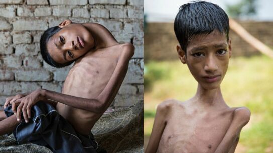 Mahendra Ahirwar antes y despu&eacute;s de la operaci&oacute;n de cuello