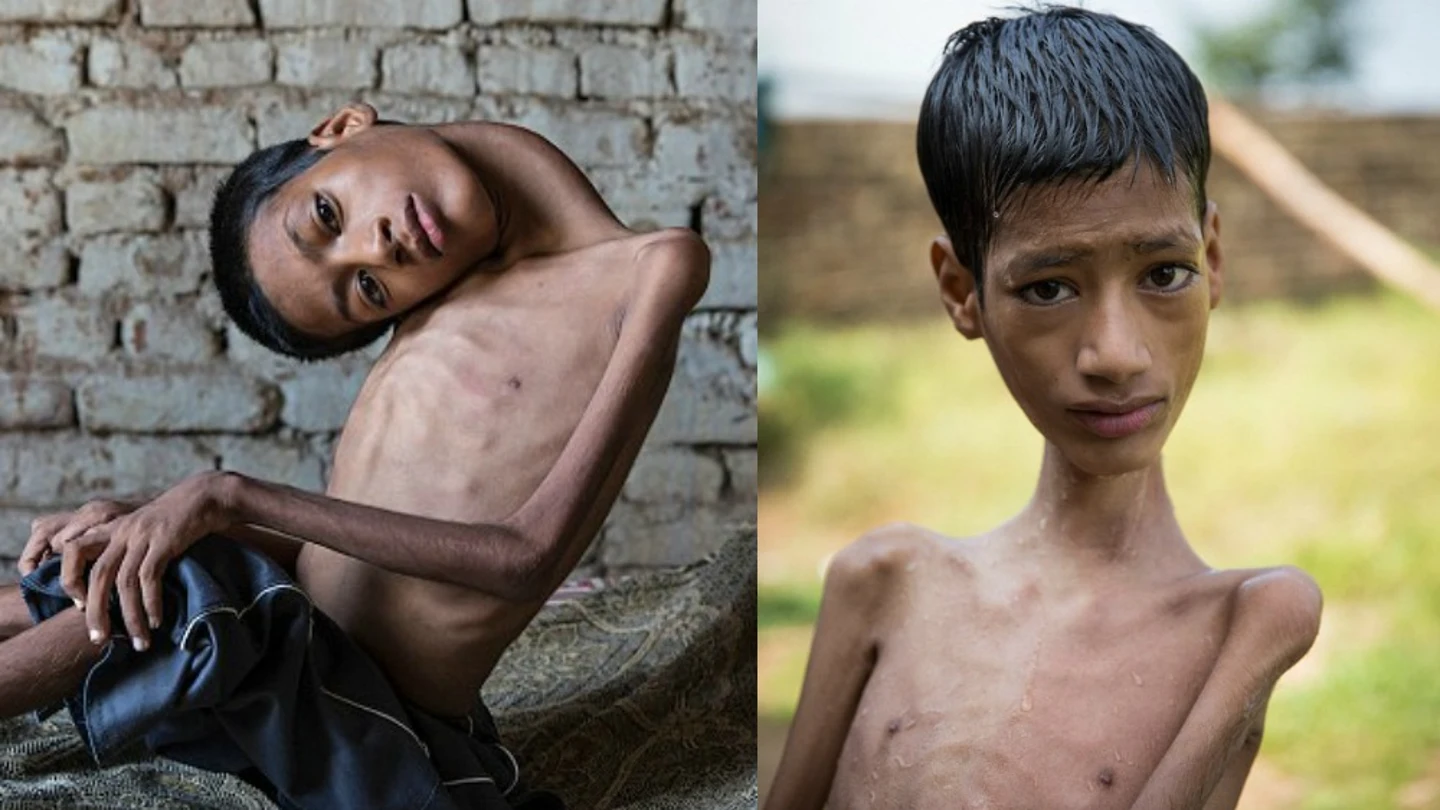 Mahendra Ahirwar antes y después de la operación de cuello Mahendra Ahirwar antes y después de la operación de cuello