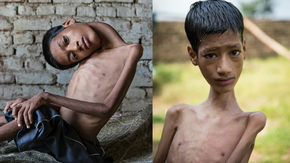 Mahendra Ahirwar antes y después de la operación de cuello