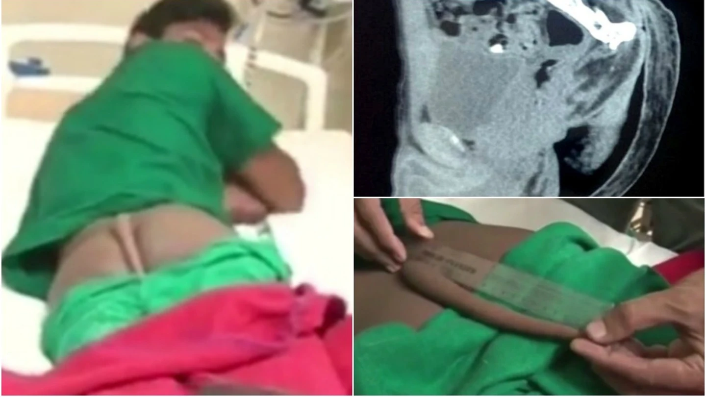Finalmente un equipo de seis médicos eliminó con éxito la malformación del jóven Finalmente un equipo de seis médicos eliminó con éxito la malformación del jóven