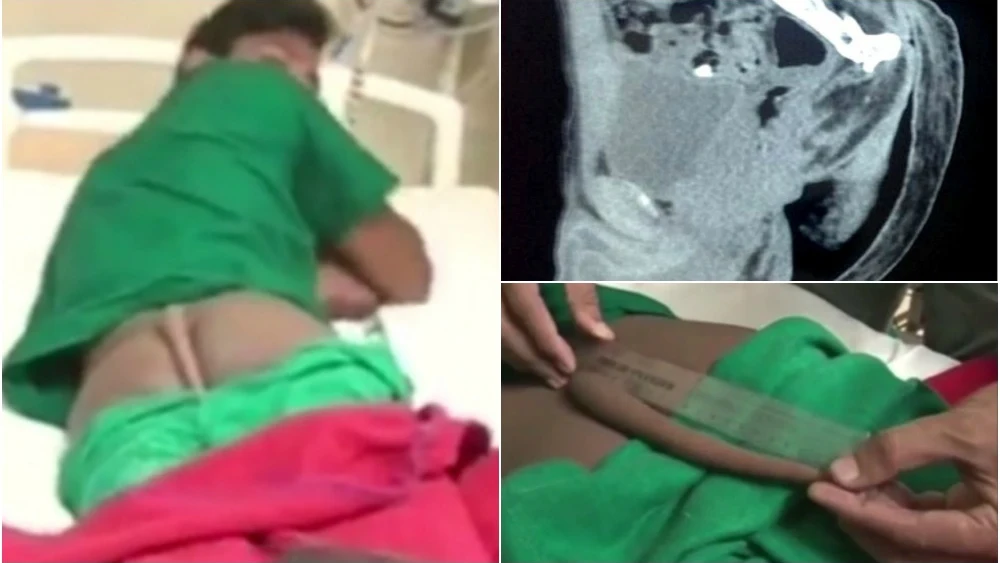 Finalmente un equipo de seis médicos eliminó con éxito la malformación del jóven