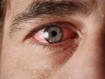 Daño en los ojos Daño en los ojos