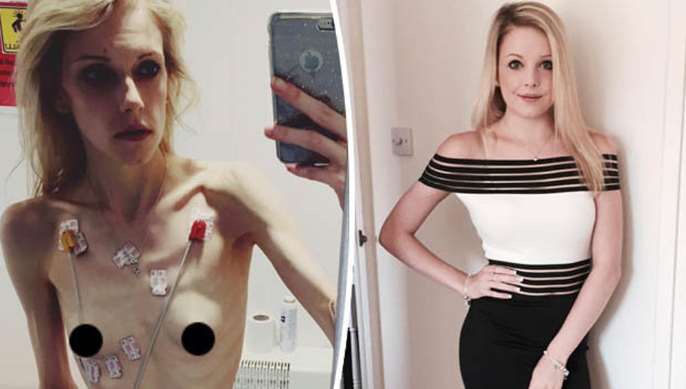 Una joven planta cara a la anorexia y logra pasar de 35 a 63 kilos: "E...