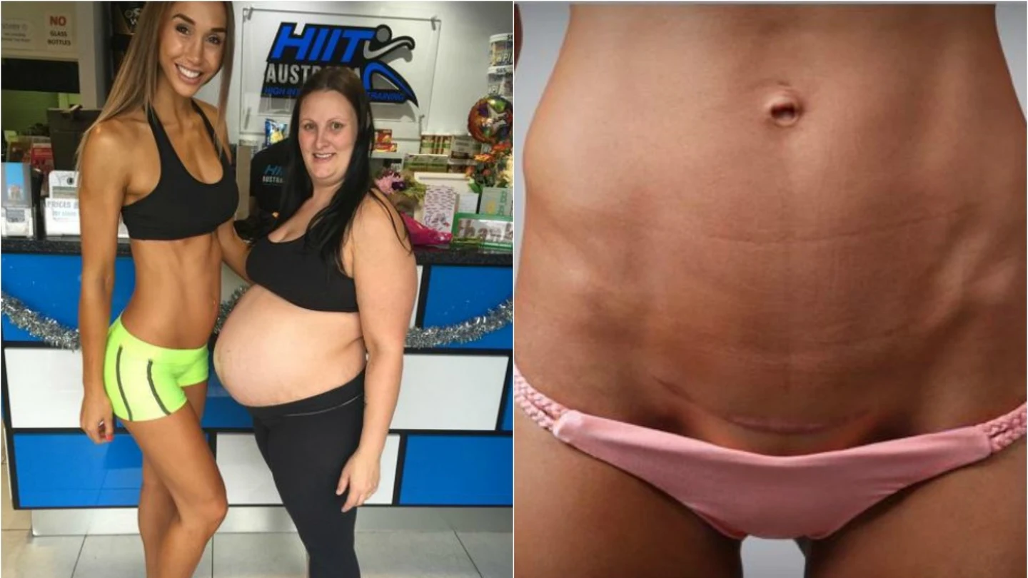 Chontel (izqda) compara su embarazo con el de otra madre y, en la imagen de la derecha, muestra la cicatriz del parto Chontel (izqda) compara su embarazo con el de otra madre y, en la imagen de la derecha, muestra la cicatriz del parto
