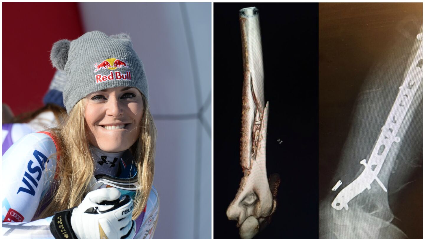 Fractura de h&uacute;mero de Lindsey Vonn
