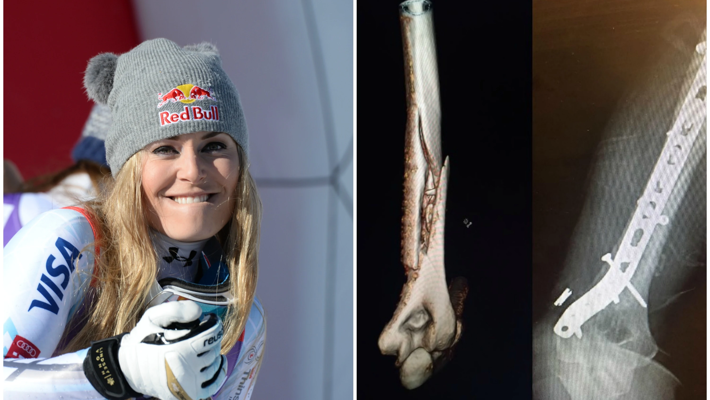 Fractura de húmero de Lindsey Vonn