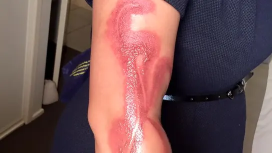 Las quemaduras que ha sufrido en el brazo Las quemaduras que ha sufrido en el brazo