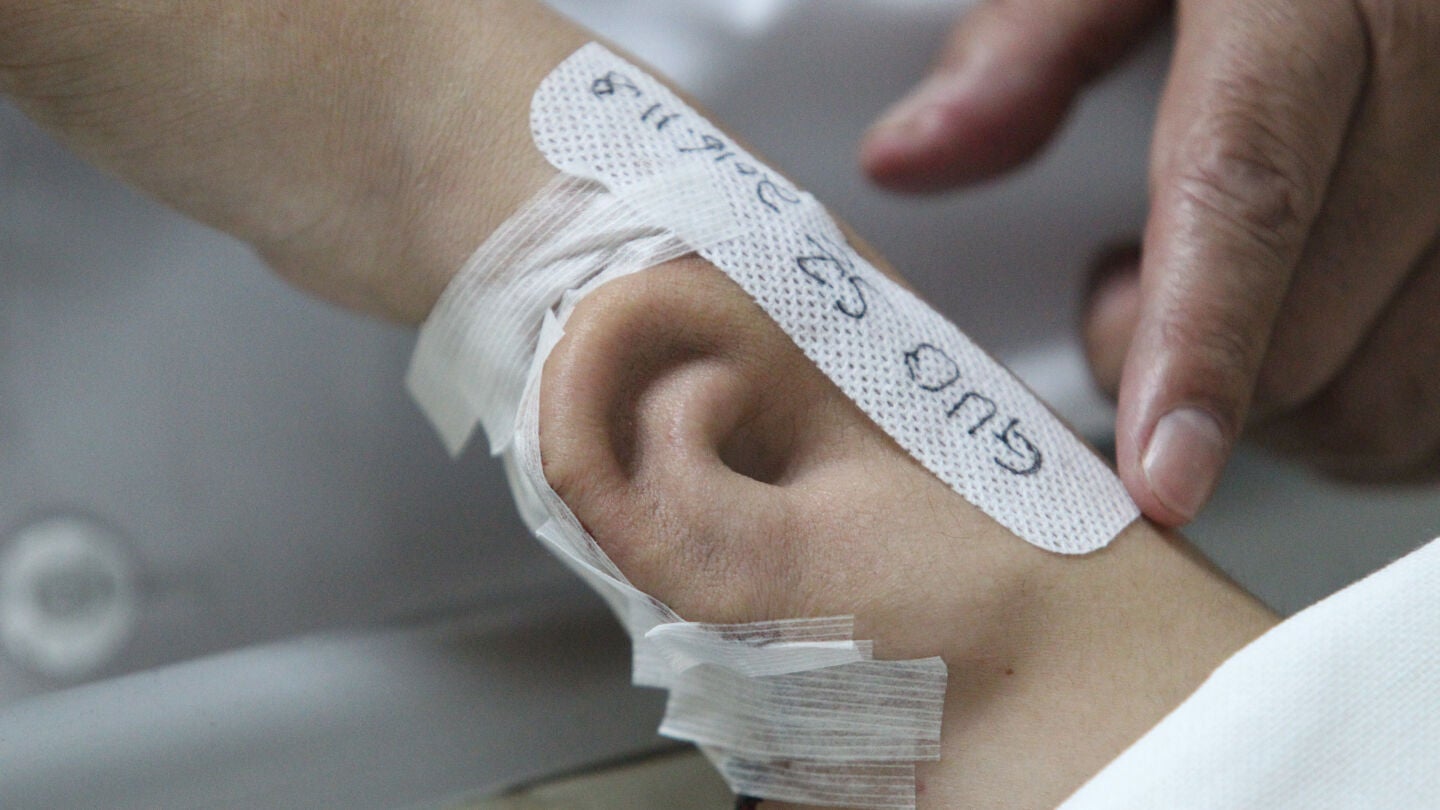 Crean una oreja en el brazo
