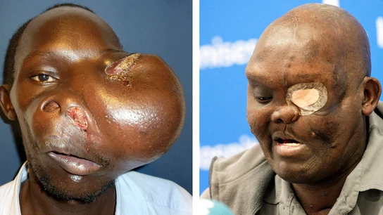 El paciente Mike Koech en dos imágenes, antes y despues, de ser operado por el doctor Pedro Cavadas  El paciente Mike Koech en dos imágenes, antes y despues, de ser operado por el doctor Pedro Cavadas