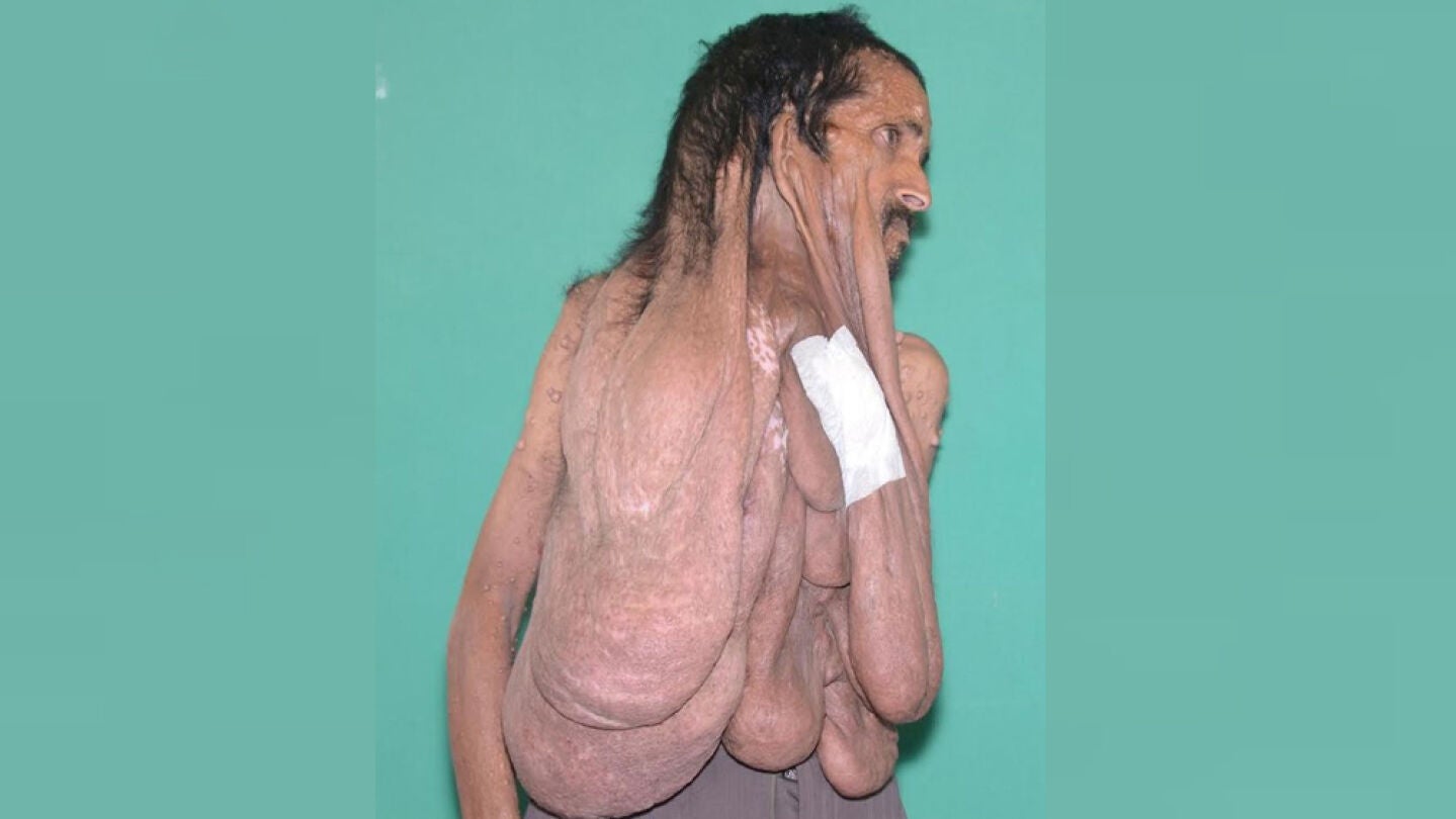 Ciudadano nepal&iacute; con un tumor facial